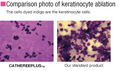 Comparison photo of keratinocyte ablation